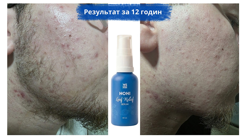 акне